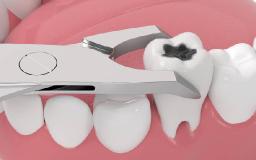 When Is a Tooth Extraction Necessary and What to Expect