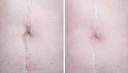 Scar Removal for Stretch Marks: What You Should Know