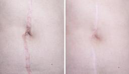 Scar Removal for Stretch Marks: What You Should Know
