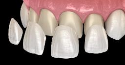 The Complete Process of Getting Dental Veneers Explained