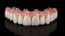 Benefits of Choosing All-on-4 Implants Over Traditional Dentures