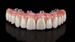 Benefits of Choosing All-on-4 Implants Over Traditional Dentures
