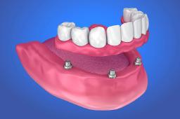 Why Implant Dentures Are Changing Modern Restorative Dentistry