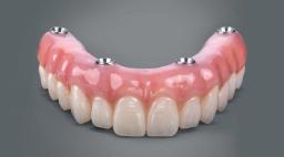 Are All-on-4 Dental Implants Right for You? Here&rsquo;s How to Decide