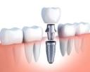 The Truth About Dental Implants: What Your Dentist Wants You to Know