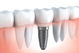 Affordable Dental Implants in Louisville: What You Should Know