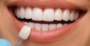 5 Signs You Might Need Dental Veneers for a Perfect Smile