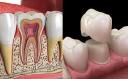 The Root Canal Process Explained: From Diagnosis to Recovery