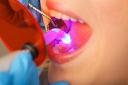 Dental Bonding: A Quick and Affordable Smile Enhancement Option