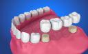 Top Benefits of Choosing Crowns and Bridges for Damaged Teeth