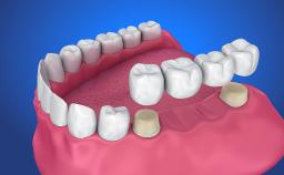 Top Benefits of Choosing Crowns and Bridges for Damaged Teeth