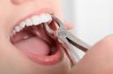 Benefits of Choosing Immediate Implants After Tooth Extraction