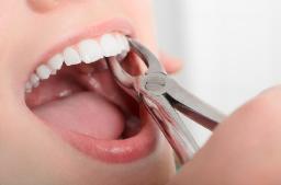 Benefits of Choosing Immediate Implants After Tooth Extraction