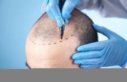 Hair Transplant Cost, Procedure, Results & Safety: Complete Guide to Natural Hair Restoration