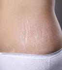 Stretch Marks: 9 Powerful Ways to Reduce, Treat & Remove Stretch Marks Naturally and with Laser Treatment