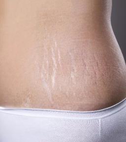 Stretch Marks: 9 Powerful Ways to Reduce, Treat & Remove Stretch Marks Naturally and with Laser Treatment