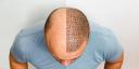 Hair Transplant Cost, Procedure, Results & Safety &ndash; Complete Expert Guide