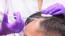 PRP Hair Treatment: The Best Solution for Hair Loss and Hair Growth