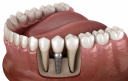 Full Arch Implant: The Complete Smile Rebuild That Lasts a Lifetime