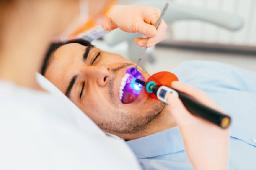 Why Dental Sealants Are Important for Cavity Prevention