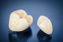 What to Expect During a CEREC Same-Day Crown Procedure
