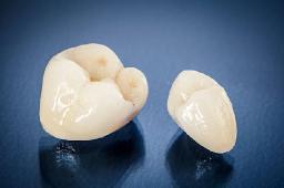 What to Expect During a CEREC Same-Day Crown Procedure