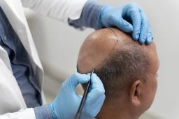 I Got a Hair Transplant &mdash; Here's Everything Nobody Told Me (Cost, Results & More)