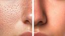 Open Pores on Face: Causes, Treatment & How to Get Rid of Them for Good