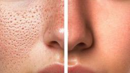 Open Pores on Face: Causes, Treatment & How to Get Rid of Them for Good