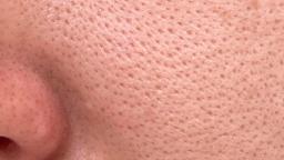 Open Pores Treatment: The Complete Expert Guide