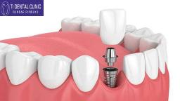 Porcelain Veneers vs Composite Veneers