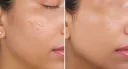 The Complete Guide to Open Pores: Solutions, Treatments & Skincare That Actually Works