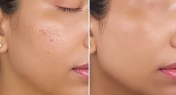 The Complete Guide to Open Pores: Solutions, Treatments & Skincare That Actually Works