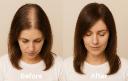 Everything You Need to Know About Exosomes for Hair: Your Complete Patient Guide