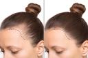 تقنيات FUE المتطورة لزراعة الشعر في دبي: الرفاهية تلتقي بالعلم