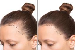 تقنيات FUE المتطورة لزراعة الشعر في دبي: الرفاهية تلتقي بالعلم