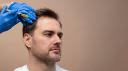 Hair Transplant Turkey: Affordable Solutions for Hair Loss