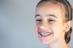 The Science Behind Orthodontic Braces: Achieving Perfect Dental Alignment in San Antonio