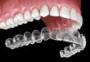  How Teeth Aligners Work Step By Step For Perfect Results?
