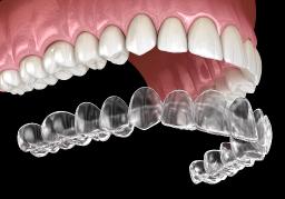 How Aligners Help With Mild To Moderate Teeth Crowding?